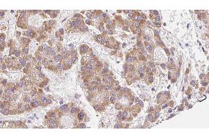 ABIN6279113 at 1/100 staining Human liver cancer tissue by IHC-P. (SCNN1A 抗体  (Internal Region))