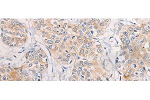 Immunohistochemistry of paraffin-embedded Human prost at e cancer tissue using CPD Polyclonal Antibody at dilution of 1:70(x200) (CPD 抗体)