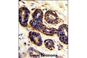 Formalin-fixed and paraffin-embedded human breast carcinoma with BEST2 Antibody (C-term), which was peroxidase-conjugated to the secondary antibody, followed by DAB staining. (Bestrophin 2 抗体  (C-Term))