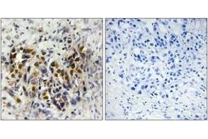 Immunohistochemistry analysis of paraffin-embedded human breast carcinoma tissue, using IRX3 Antibody. (IRX3 抗体  (AA 271-320))