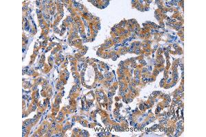 Immunohistochemistry of Human liver cancer using IGSF10 Polyclonal Antibody at dilution of 1:50 (IGSF10 抗体)