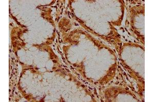 IHC image of ABIN7169084 diluted at 1:300 and staining in paraffin-embedded human stomach cancer performed on a Leica BondTM system. (PKN3 抗体  (AA 1-252))
