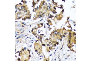 Immunohistochemistry of paraffin-embedded human lung cancer using Ube2N/Ubc13 Rabbit mAb (ABIN7271179) at dilution of 1:100 (40x lens). (UBE2N 抗体)