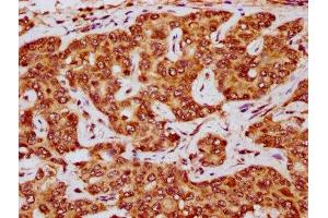 IHC image of ABIN7172525 diluted at 1:200 and staining in paraffin-embedded human liver cancer performed on a Leica BondTM system. (E2F5 抗体  (AA 193-298))