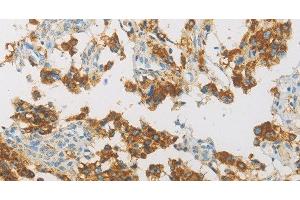 Immunohistochemistry of paraffin-embedded Human thyroid cancer using IDH3G Polyclonal Antibody at dilution of 1:30 (IDH3G 抗体)