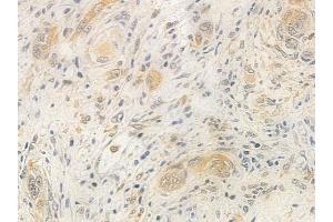 ABIN6261486 and ABIN6277500 at 1/100 staining human tongue carcinoma by IHC-P. (EIF4A1 抗体  (N-Term))