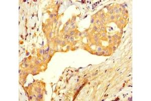 Immunohistochemistry of paraffin-embedded human breast cancer using ABIN7174485 at dilution of 1:100 (Ube2t 抗体  (AA 1-197))