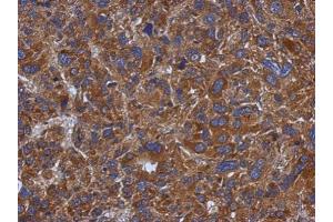 IHC-P Image Immunohistochemical analysis of paraffin-embedded human hepatoma, using TXNDC5, antibody at 1:500 dilution. (TXNDC5 抗体)