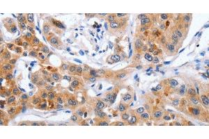 Immunohistochemistry of paraffin-embedded Human lung cancer using NCK1 Polyclonal Antibody at dilution of 1:30 (NCK1 抗体)