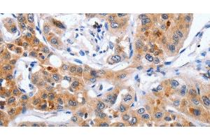 Immunohistochemistry of paraffin-embedded Human lung cancer using NCK1 Polyclonal Antibody at dilution of 1:30 (NCK1 抗体)