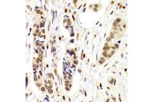 Immunohistochemistry of paraffin-embedded Human mammary cancer using NASP antibody at dilution of 1:100 (x400 lens). (NASP 抗体)