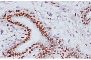 Immunohistochemistry of paraffin-embedded Human breast cancer using Acetyl-Histone H3-K9/K14/K18/K23/K27 Polyclonal Antibody at dilution of 1:100 (40x lens). (Histone 3 抗体  (acLys9, acLys14, acLys18, acLys23, acLys27))