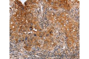 Immunohistochemistry of Human cervical cancer using PLAUR Polyclonal Antibody at dilution of 1:60 (PLAUR 抗体)