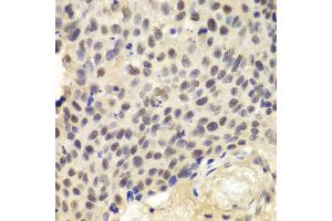 Immunohistochemistry of paraffin-embedded human lung cancer using KPNA1 antibody at dilution of 1:100 (400x lens). (KPNA1 抗体)