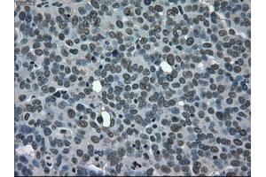 Immunohistochemical staining of paraffin-embedded Adenocarcinoma of ovary tissue using anti-CD4mouse monoclonal antibody. (CD4 抗体)
