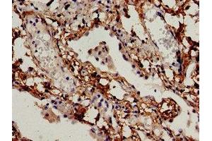 Immunocytochemistry analysis of human lung cancer using ABIN7145302 at dilution of 1:100 (BIM 抗体  (AA 1-198))