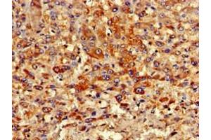 Immunohistochemistry of paraffin-embedded human liver cancer using ABIN7162982 at dilution of 1:100 (PIPOX 抗体  (AA 259-337))