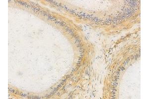 ABIN6265066 and ABIN6266633 at 1/100 staining human testicular cancer by IHC-P. (INPP5D 抗体  (C-Term))
