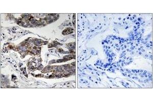 Immunohistochemistry analysis of paraffin-embedded human breast carcinoma, using Girdin (Phospho-Ser1417) Antibody. (Girdin 抗体  (pSer1417))
