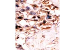 Formalin-fixed and paraffin-embedded human cancer tissue´(hepatocarcinoma) reacted with the primary antibody, which was peroxidase-conjugated to the secondary antibody, followed by DAB staining. (UCKL1 抗体  (N-Term))