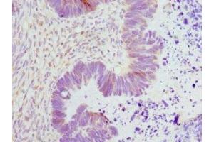 Immunohistochemistry of paraffin-embedded human ovarian cancer using ABIN7151362 at dilution of 1:100 (ENOX2 抗体  (AA 411-610))