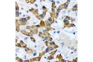Immunohistochemical analysis of HAO1 staining in human liver cancer formalin fixed paraffin embedded tissue section. (HAO1 抗体)