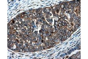 Immunohistochemical staining of paraffin-embedded Adenocarcinoma of colon tissue using anti-IFT57mouse monoclonal antibody. (IFT57 抗体)