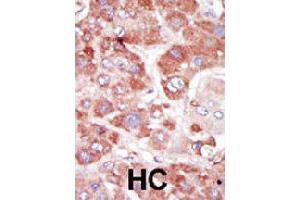 Formalin-fixed and paraffin-embedded human hepatocellular carcinoma tissue reacted with GRK7 polyclonal antibody  , which was peroxidase-conjugated to the secondary antibody, followed by AEC staining. (GRK7 抗体  (C-Term))
