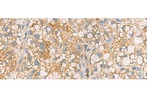 Immunohistochemistry of paraffin-embedded Human liver cancer tissue using ANXA13 Polyclonal Antibody at dilution of 1:105(x200) (Annexin A13 抗体)