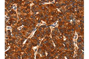 The image on the left is immunohistochemistry of paraffin-embedded Human liver cancer tissue using ABIN7190469(DHH Antibody) at dilution 1/25, on the right is treated with synthetic peptide. (desert Hedgehog 抗体)