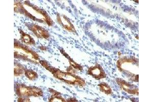 Formalin-fixed, paraffin-embedded human gastric carcinoma stained with Mucin-6 antibody (MUC6/916). (MUC6 抗体)