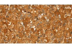 Immunohistochemistry of paraffin-embedded Human liver cancer using PYGM Polyclonal Antibody at dilution of 1:30 (PYGM 抗体)