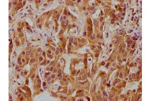 IHC image of ABIN7146186 diluted at 1:300 and staining in paraffin-embedded human liver cancer performed on a Leica BondTM system. (CELSR3 抗体  (AA 514-718))