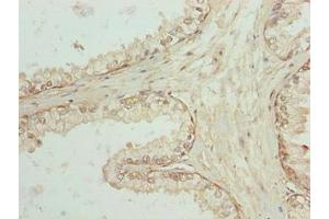 Immunohistochemistry of paraffin-embedded human prostate cancer using ABIN7168900 at dilution of 1:100 (SPTLC3 抗体  (AA 1-58))