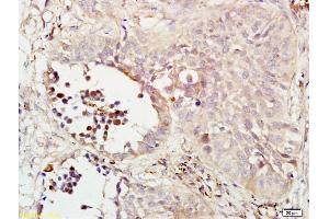 Formalin-fixed and paraffin embedded human lung carcinoma labeled with Rabbit Anti phospho-MEK1/MAPKK1(Ser298) Polyclonal Antibody, Unconjugated (ABIN733703) at 1:200 followed by conjugation to the secondary antibody and DAB staining (MEK1 抗体  (pSer298))