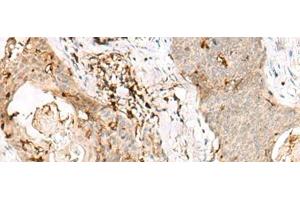Immunohistochemistry of paraffin-embedded Human esophagus cancer tissue using OVOL2 Polyclonal Antibody at dilution of 1:50(x200) (OVOL2 抗体)