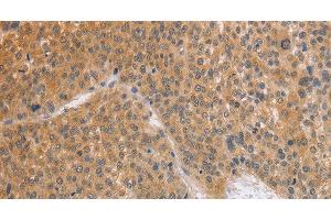 Immunohistochemistry of paraffin-embedded Human liver cancer using BRS3 Polyclonal Antibody at dilution of 1:50 (BRS3 抗体)