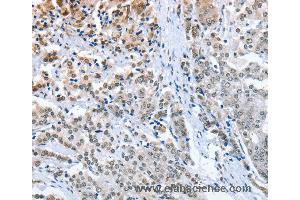 Immunohistochemistry of Human prostate cancer using ELAVL1 Polyclonal Antibody at dilution of 1:50 (ELAVL1 抗体)