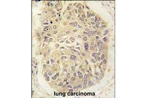 Formalin-fixed and paraffin-embedded human lung carcinoma tissue reacted with FARSA antibody (N-term) (ABIN391817 and ABIN2841665) , which was peroxidase-conjugated to the secondary antibody, followed by DAB staining. (Phenylalanyl-tRNA Synthetase, alpha Subunit (FARSA) (AA 54-83), (N-Term) 抗体)