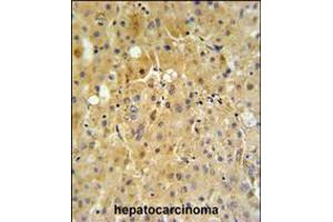 P450R Antibody IHC analysis in formalin fixed and paraffin embedded human hepatocarcinoma tissue followed by peroxidase conjugation of the secondary antibody and DAB staining. (CYP2B6 抗体  (AA 462-488))