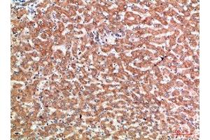 Immunohistochemical analysis of paraffin-embedded human-liver-cancer, antibody was diluted at 1:200
