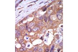 Formalin-fixed and paraffin-embedded human cancer tissue reacted with the primary antibody, which was peroxidase-conjugated to the secondary antibody, followed by AEC staining. (PKC mu 抗体  (N-Term))