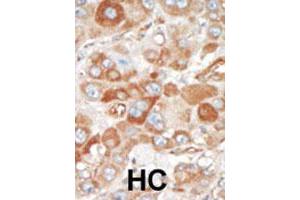 Formalin-fixed and paraffin-embedded human hepatocellular carcinoma tissue reacted with SRPK2 polyclonal antibody  , which was peroxidase-conjugated to the secondary antibody, followed by DAB staining. (SRPK2 抗体  (C-Term))