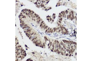 Immunohistochemistry of paraffin-embedded human lung cancer using ST Rabbit pAb (ABIN3020614, ABIN3020615, ABIN3020616 and ABIN6213588) at dilution of 1:50 (40x lens). (STAT1 抗体  (AA 513-712))