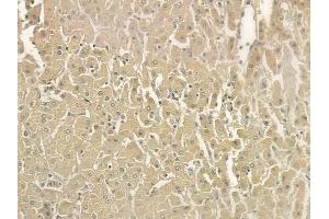 at 1/100 staining human hepatocellular carcinoma by IHC-P. (HCLS1 抗体  (Internal Region))