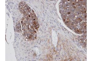 IHC-P Image Immunohistochemical analysis of paraffin-embedded human serous ovarian cancer, using MSLN, antibody at 1:100 dilution. (Mesothelin 抗体)