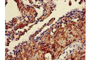 Immunohistochemistry of paraffin-embedded human lung cancer using ABIN7152377 at dilution of 1:100 (CAPZA2 抗体  (AA 2-286))