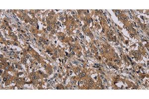 Immunohistochemistry of paraffin-embedded Human liver cancer tissue using MAL Polyclonal Antibody at dilution 1:30 (MAL 抗体)