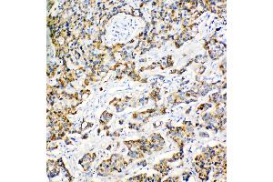 Anti-Peroxiredoxin 3 antibody, IHC(P) IHC(P): Human Mammary Cancer Tissue