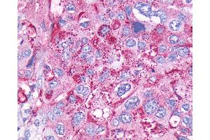 Anti-CCKBR / Cckb antibody IHC of human Pancreas, Carcinoma. (CCKBR 抗体  (Cytoplasmic Domain))